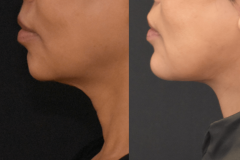 2_Chin-Implant-Neck-Lift-Combo