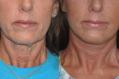 2_Dickinson-Lower-Face-and-Necklift