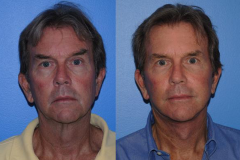 Facelift-Surgery_Males