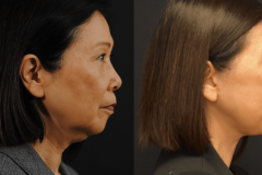 Lower-Face-Necklift-Before-and-After-Side-Profile
