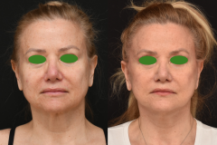 Lower-Face-and-Neck-Lift-Brian-P.-Dickinson-M.D-Newport-Beach-CA-Facial-Plastic-Surgery