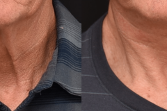 Male-Lower-Face-Neclift-Newport-Beach-CA-Brian-P.-Dickinson-M.D-1
