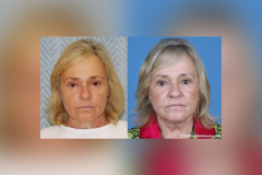 normal-Facelift-Deep-Plane_cosmetic_surgeon