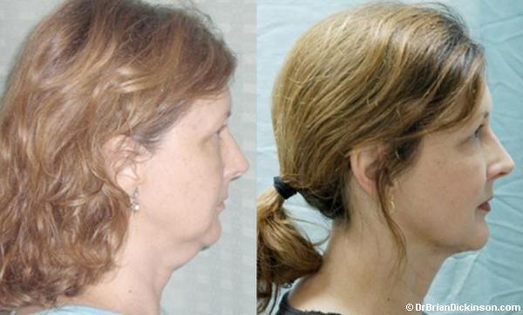 1_Liposuction-Neck-Facial-Rejuvenation-Dickinson