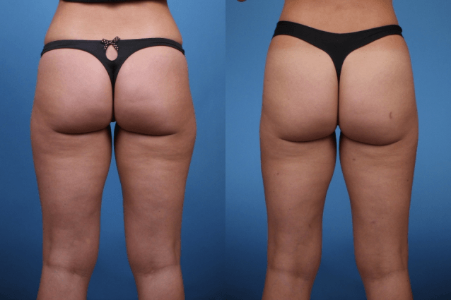 Liposuction-OUter-Thighs