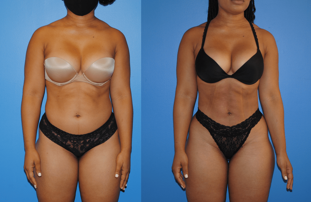 Liposuction-and-Gluteal-Fat-Transfer-Front-View