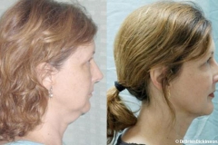 1_Liposuction-Neck-Facial-Rejuvenation-Dickinson