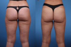 1_Liposuction-OUter-Thighs