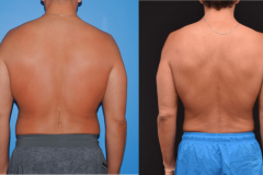 Back-Flank-Liposuction-2-Year-Follow-up-Brian-DIckinson-M.D.