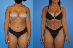 Liposuction-and-Gluteal-Fat-Transfer-Front-View