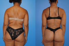 Liposuction-and-Gluteal-Fat-Transfer-Posterior-View