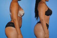 Liposuction-and-Gluteal-Fat-Transfer-Profile-View