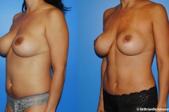 Liposuction_tummy_plastic_surgeon