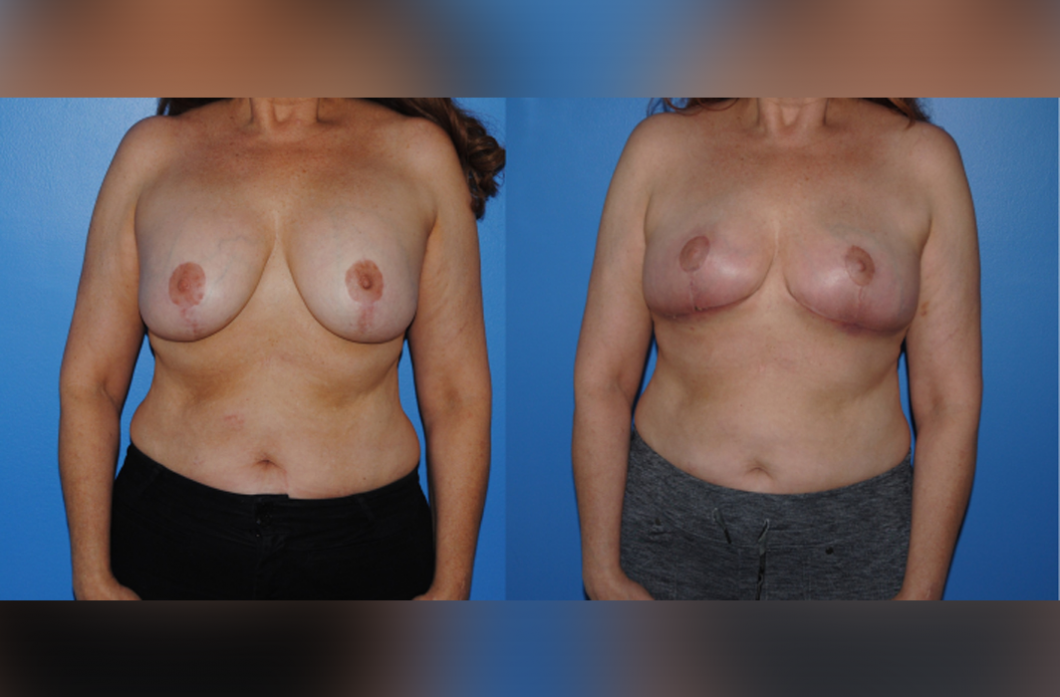 1_Mastopexy_with_Implants_Removal