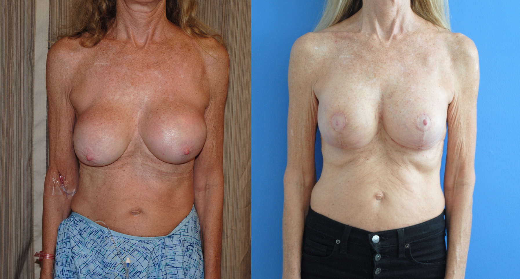 Breast Lift with Removal and Replacement of Breast Implants