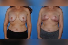1_Mastopexy_with_Implants_Removal