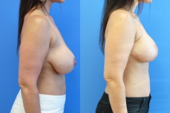 Mastopexy-Augmentation-Breast-Augmentation-Breast-Implants-Brian-Dickinson-M.D