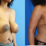 Mastopexy-Breast-Lift-Removal-and-Replacement-Newport-Beach-Brian-Dickinson-M.D
