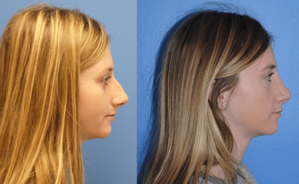 1_Rhinoplasty-Dorsal-Hump-Reduction-Natural-Results