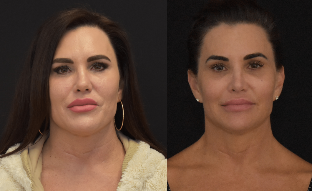 Rhinoplasty-Before-and-After-Nasal-Dorsum-and-Nasal-Tip-Modification-Brian-P.-Dickinson-M.D.