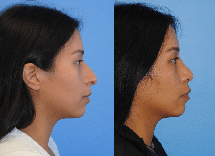 Rhinoplasty-Side-Profile-and-Projection