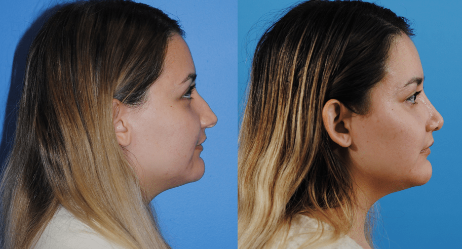 Rhinoplasty-Tip-Projection-and-Nasal-Dorsum-Brian-Dickinson-M.D.