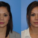 Asian Rhinoplasty for Dorsal Aesthetic Lines & Tip Definition