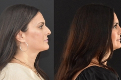 JP-Rhinoplasty-Before-and-After-Side-Profile-Sillhouette
