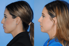 Narrowing-the-Nasal-Tip-and-Straightening-the-Nasal-Dorsum-Profile