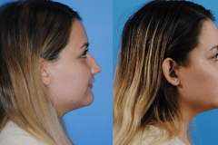 Rhinoplasty-Tip-Projection-and-Nasal-Dorsum-Brian-Dickinson-M.D.