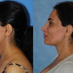Middle Eastern Primary Rhinoplasty to Correct Dorsal Hump