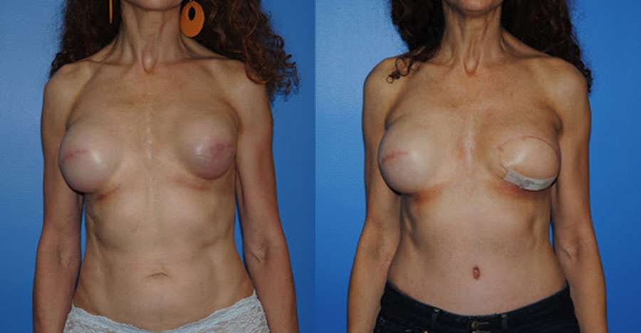 Staged DIEP & Implant Breast Reconstruction following Radiation Therapy