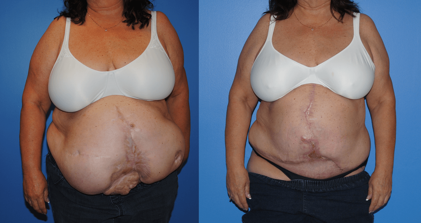 Hernia Reconstruction with Component Separation and Tensor Fascia Lata Flap