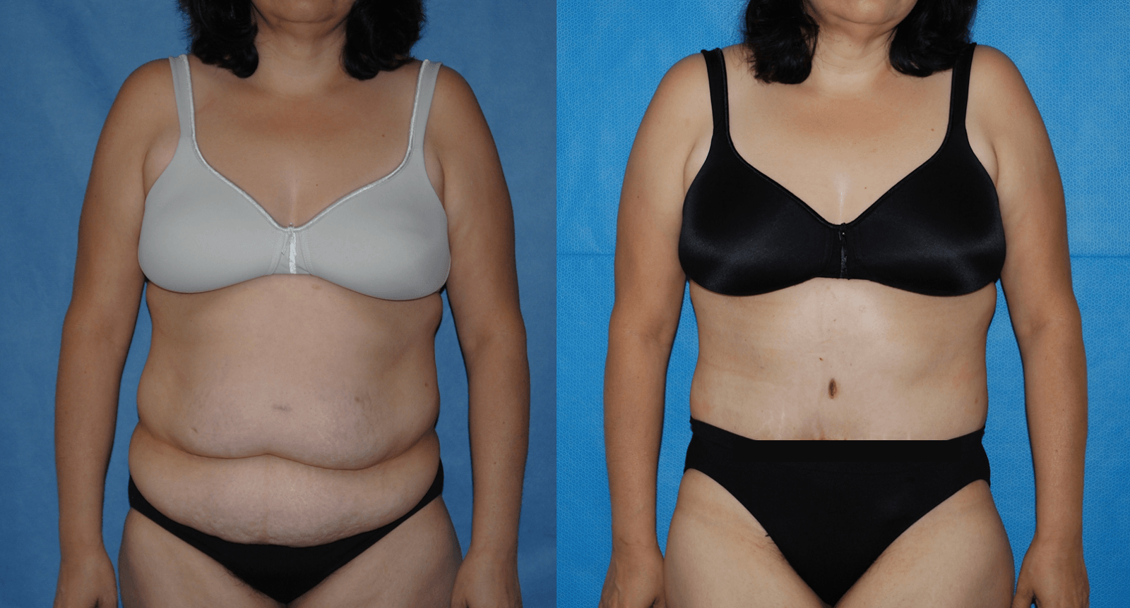 Abdominoplasty in the Weight Loss Surgery Patient