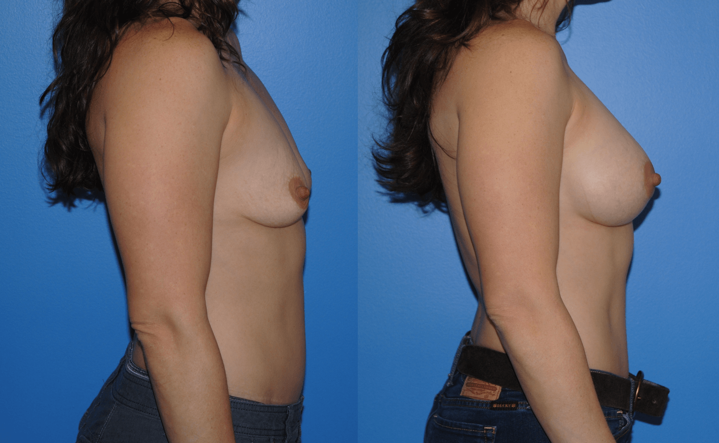Breast Augmentation Pain Medication Questions
