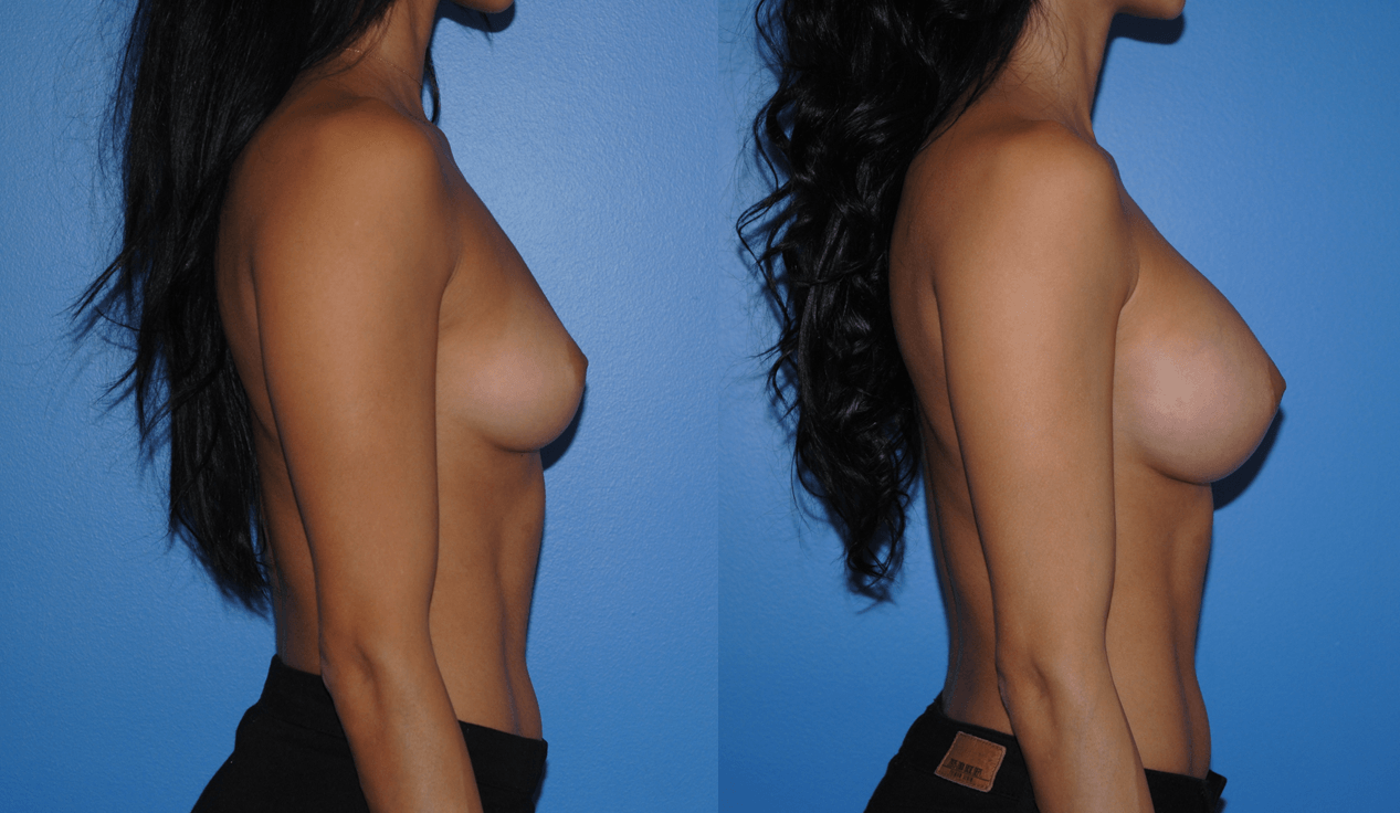 Natural Looking Breast Augmentation