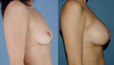 Breast Implants_Los Angeles_Silicone Implant_Brian Dickinson MD