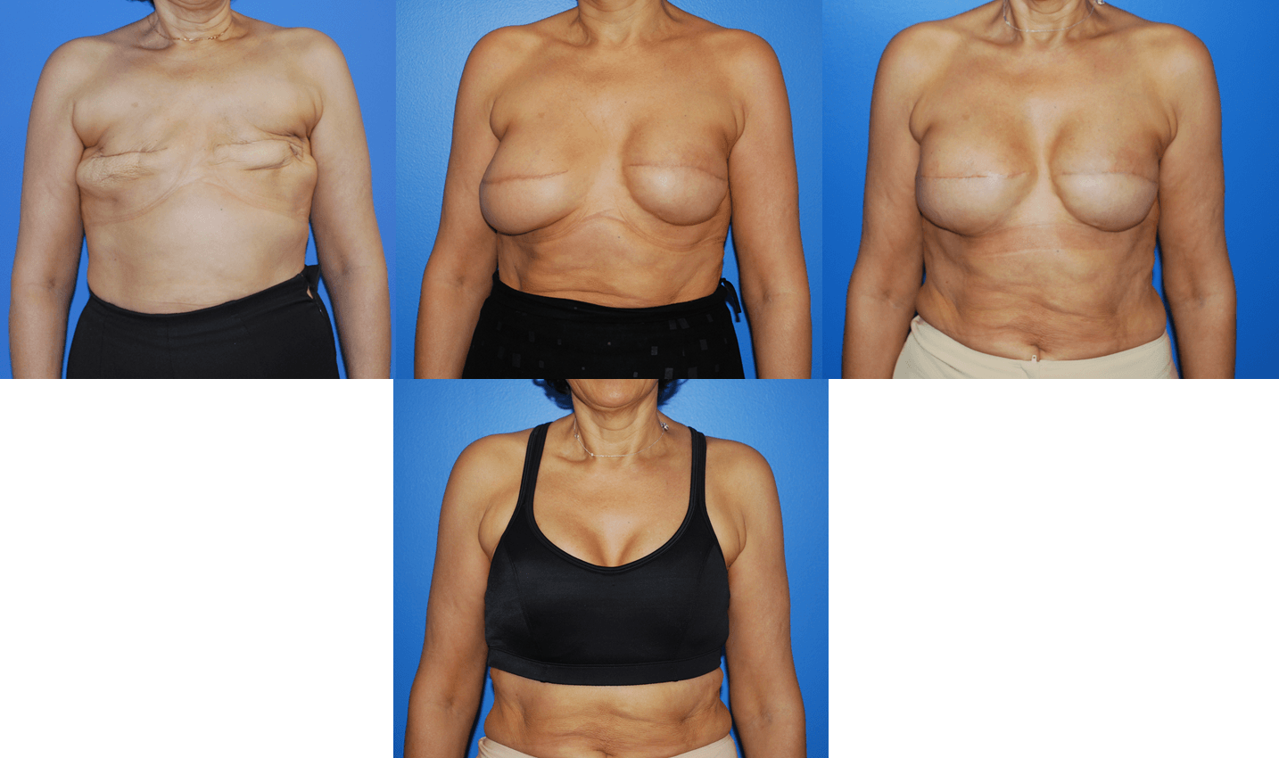 Silicone Breast Implant Reconstruction