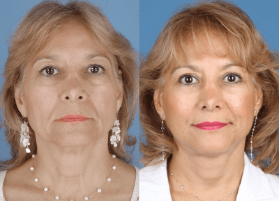 Facelift and Facial Rejuvenation Surgery