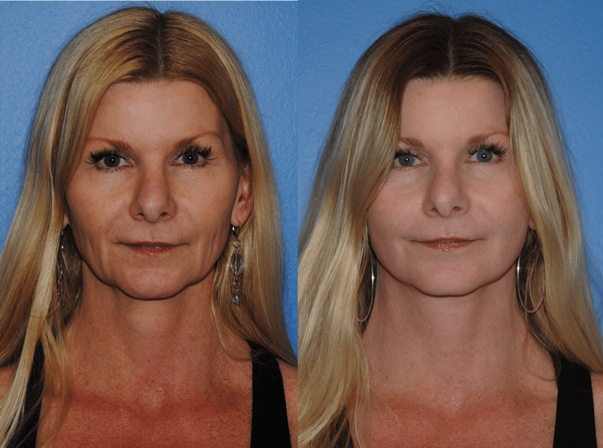 Women Facelifts