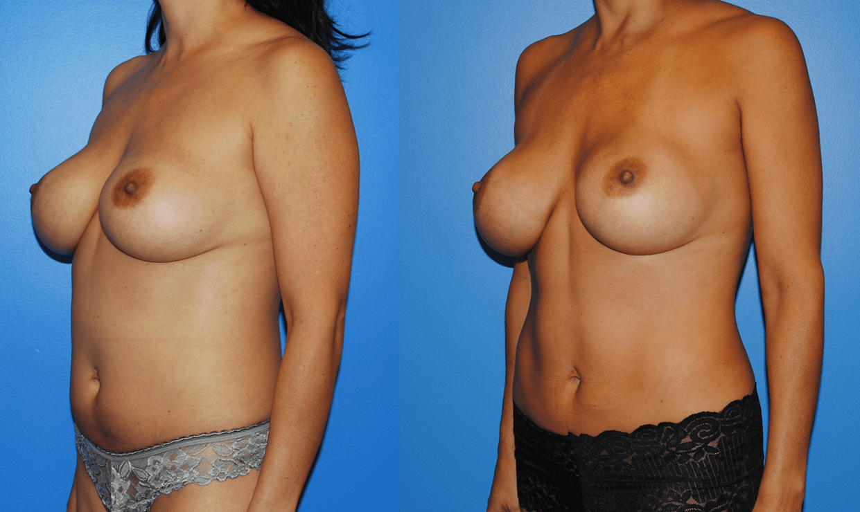 Liposuction and Mini Tummy Tuck
