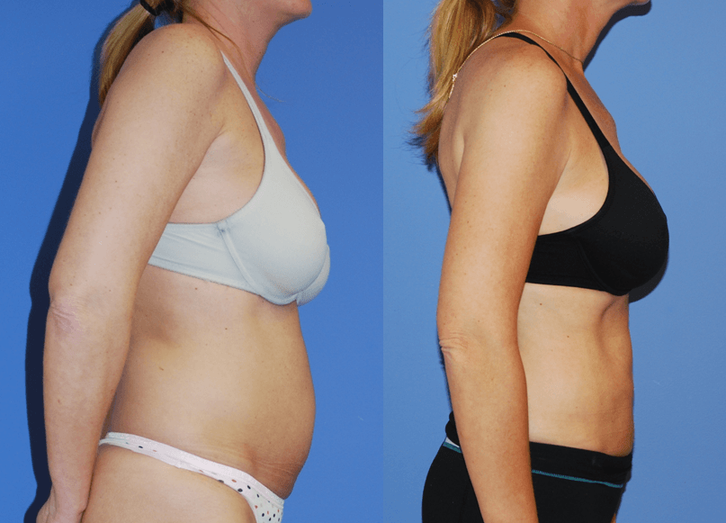Liposuction of the Abdomen