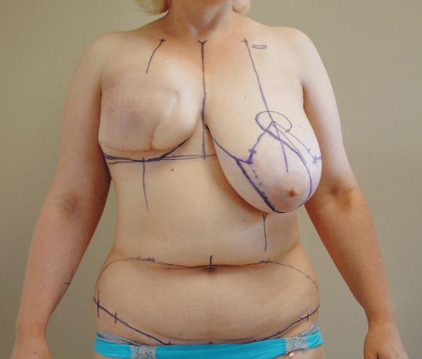 Pre op breast reconstruction 