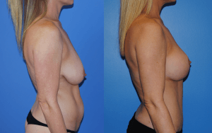 Abdominoplasty Newport Beach