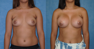 Breast Implants - Silicone Gel before and after