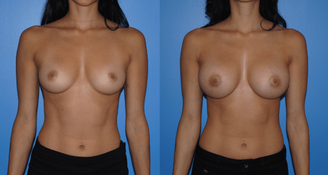 Natural Look Breast Augmentation - Areola Incision