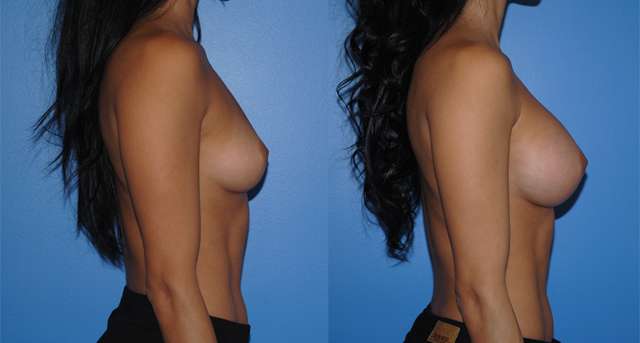 Natural Looking Silicone Breast Implants