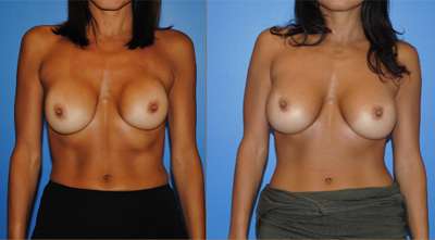 Capsular Contracture Breast Reconstruction Newport Beach