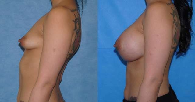 Tuberous Breast Reconstruction Newport Beach