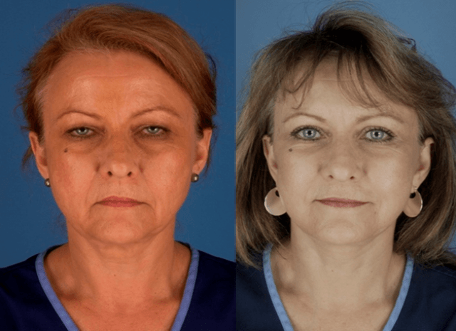 Facelift and Blepharoplasty Surgery